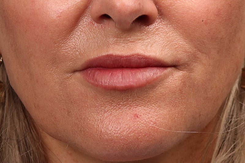 Injectables Before & After Gallery - Patient 322516 - Image 2