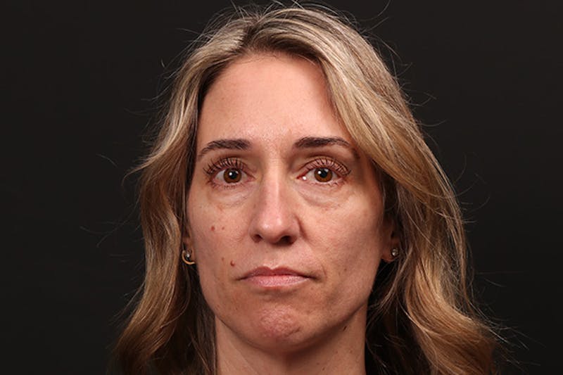Injectables Before & After Gallery - Patient 410625 - Image 1