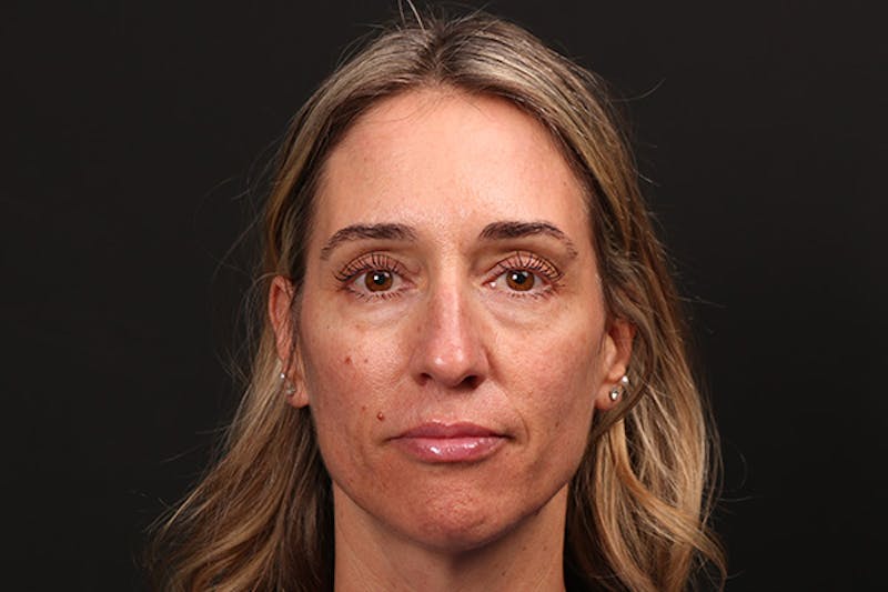 Injectables Before & After Gallery - Patient 410625 - Image 2