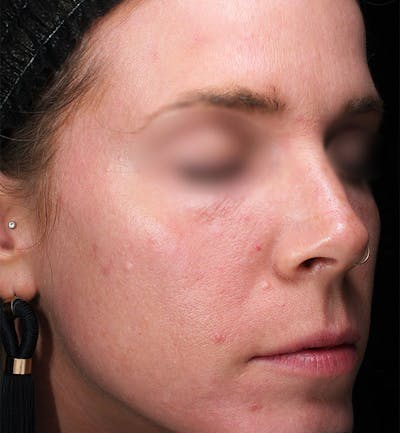BBL/Microneedling Before & After Gallery - Patient 195738 - Image 1