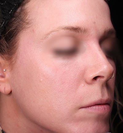 BBL/Microneedling Before & After Gallery - Patient 195738 - Image 2