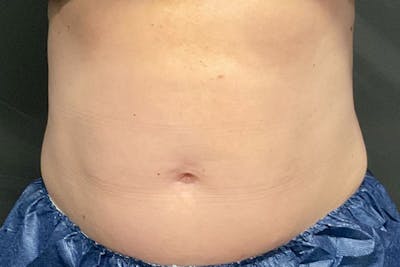 CoolSculpting Before & After Gallery - Patient 270850 - Image 1