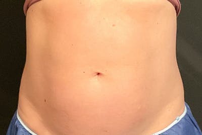 CoolSculpting Before & After Gallery - Patient 270850 - Image 2