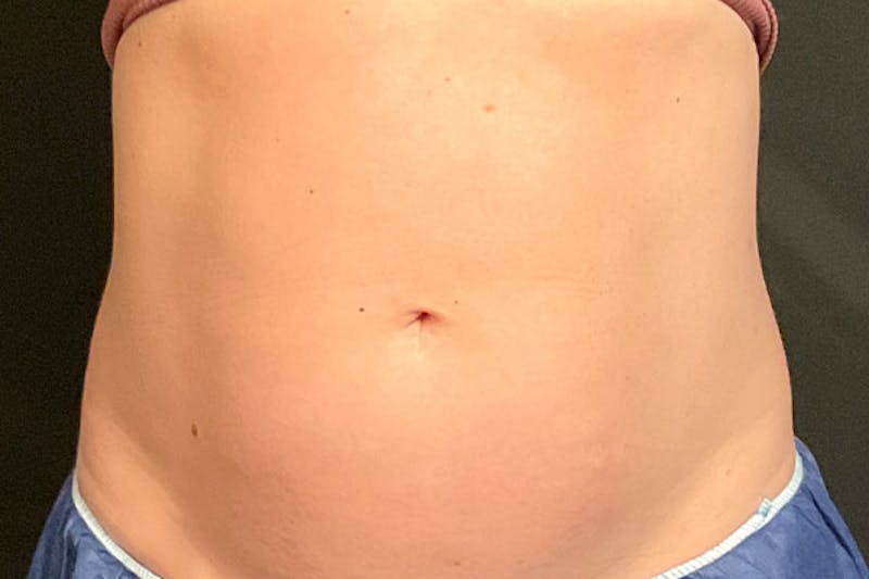 CoolSculpting Before & After Gallery - Patient 270850 - Image 2