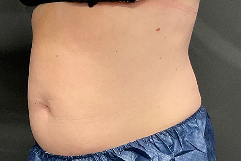 CoolSculpting Before & After Gallery - Patient 270850 - Image 3