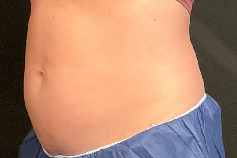 CoolSculpting Before & After Gallery - Patient 270850 - Image 4