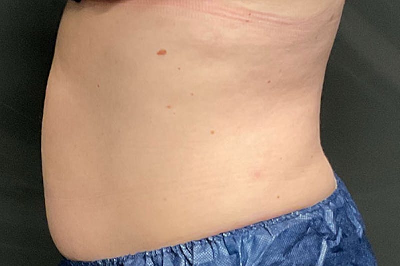 CoolSculpting Before & After Gallery - Patient 270850 - Image 5
