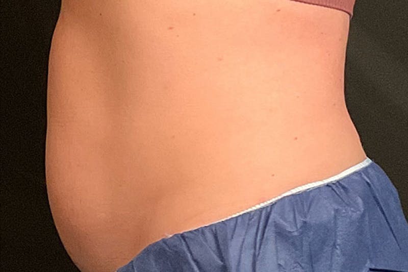 CoolSculpting Before & After Gallery - Patient 270850 - Image 6