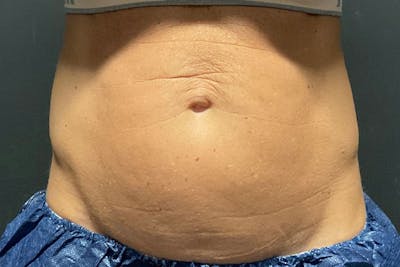 Evolve Transform Before & After Gallery - Patient 817875 - Image 1