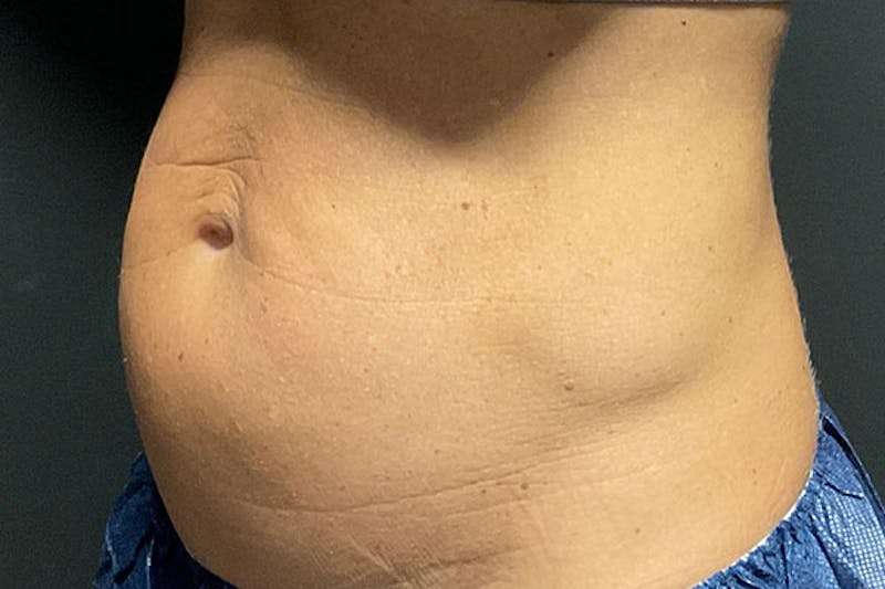 Evolve Transform Before & After Gallery - Patient 817875 - Image 3