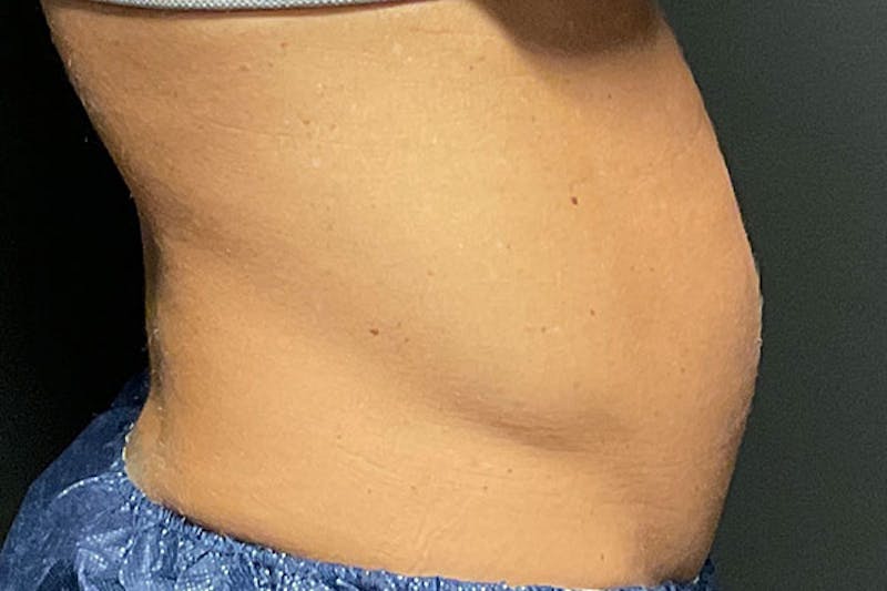 Evolve Transform Before & After Gallery - Patient 817875 - Image 5