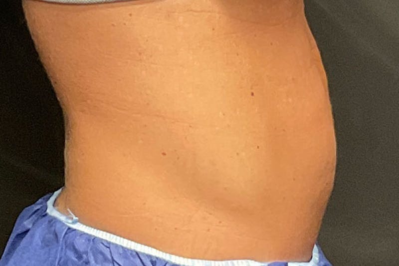 Evolve Transform Before & After Gallery - Patient 817875 - Image 6