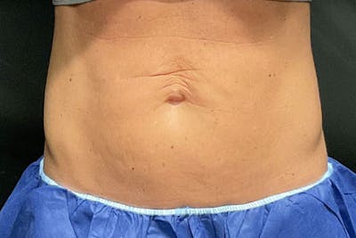 Morpheus Before & After Gallery - Patient 181272 - Image 2