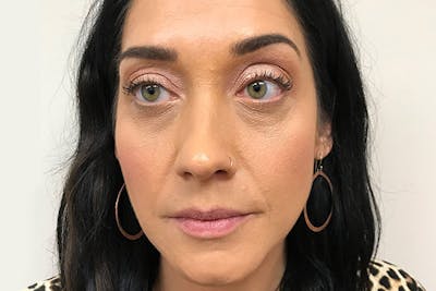 Injectables Before & After Gallery - Patient 216131 - Image 1