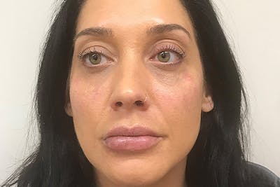 Injectables Before & After Gallery - Patient 216131 - Image 2