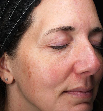 ZO Skin Before & After Gallery - Patient 598918 - Image 1
