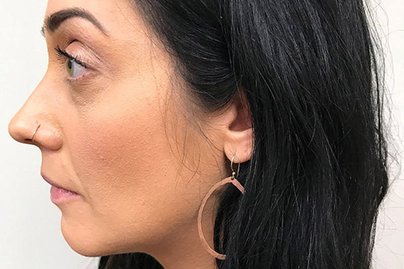 Injectables Before & After Gallery - Patient 216131 - Image 3