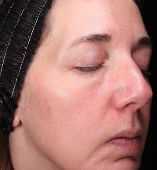 ZO Skin Before & After Gallery - Patient 598918 - Image 2