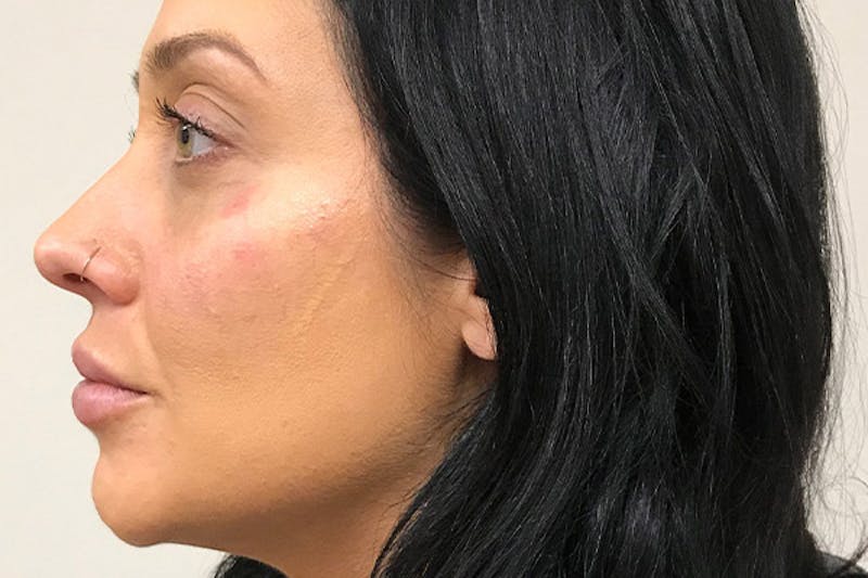Injectables Before & After Gallery - Patient 216131 - Image 4