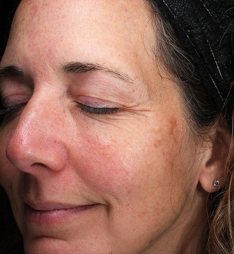 ZO Skin Before & After Gallery - Patient 598918 - Image 3