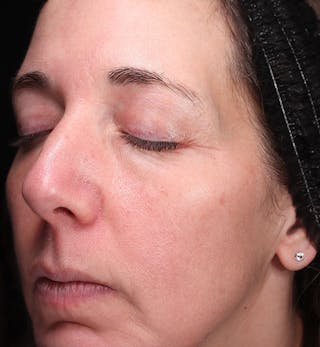 ZO Skin Before & After Gallery - Patient 598918 - Image 4