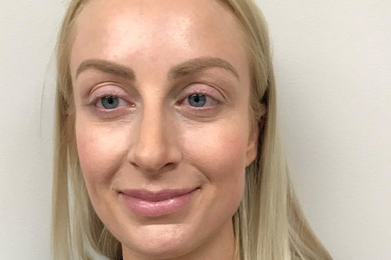Injectables Before & After Gallery - Patient 313291 - Image 1