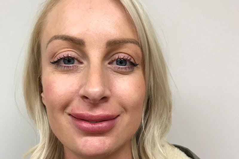 Injectables Before & After Gallery - Patient 313291 - Image 2