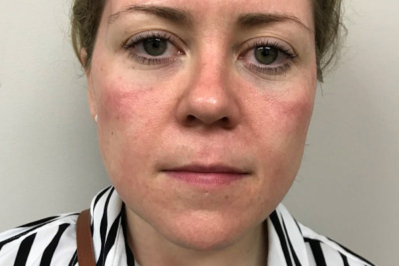 Injectables Before & After Gallery - Patient 405668 - Image 1