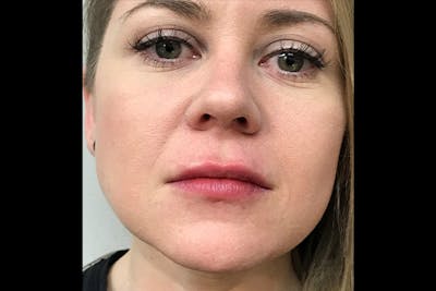 Injectables Before & After Gallery - Patient 405668 - Image 2