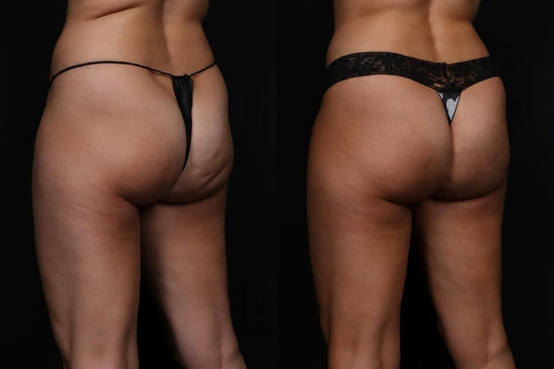 Aveli Before & After Gallery - Patient 252585 - Image 2