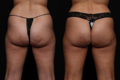 Aveli Before & After Gallery - Patient 252585 - Image 1
