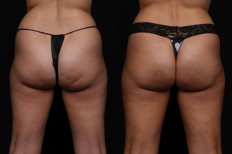 Aveli Before & After Gallery - Patient 252585 - Image 1