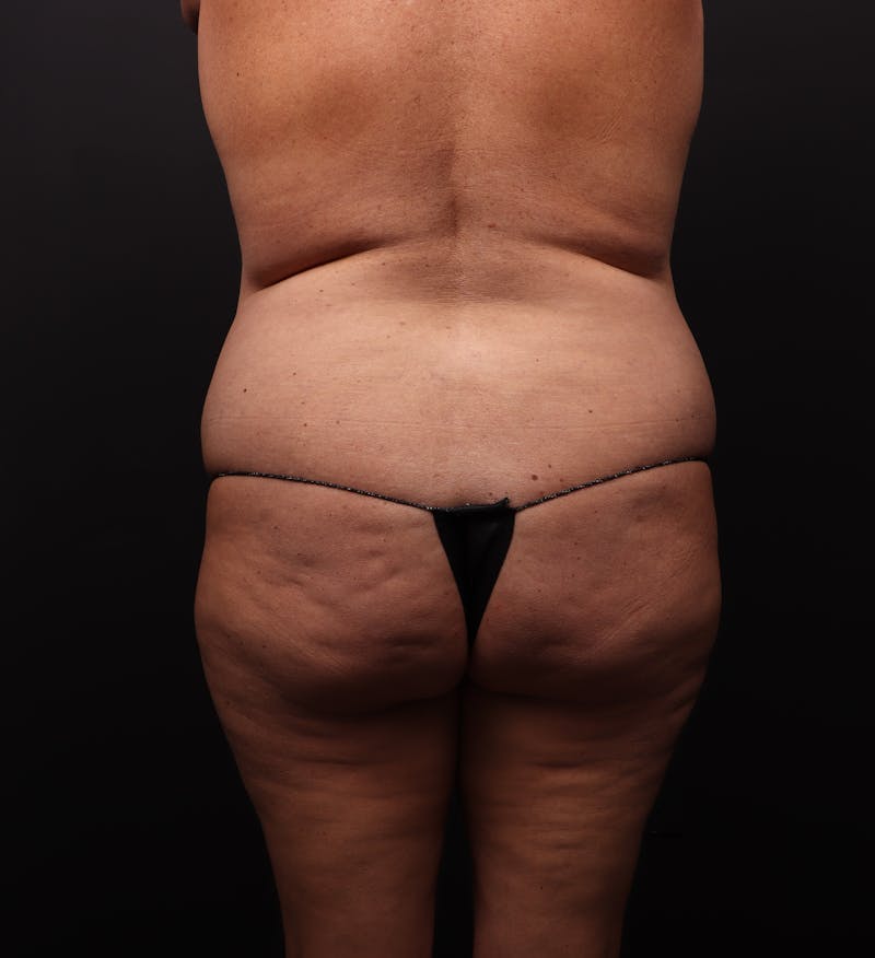 Mommy Makeover Before & After Gallery - Patient 197181 - Image 5