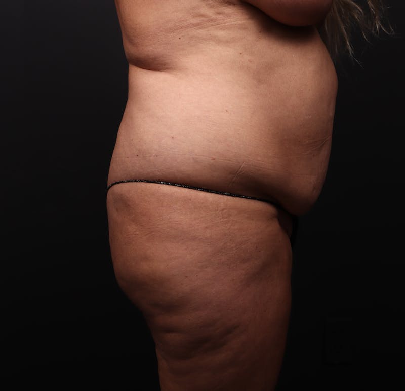 Mommy Makeover Before & After Gallery - Patient 197181 - Image 3