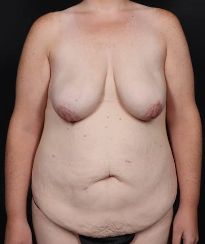 Mommy Makeover Before & After Gallery - Patient 297401 - Image 1