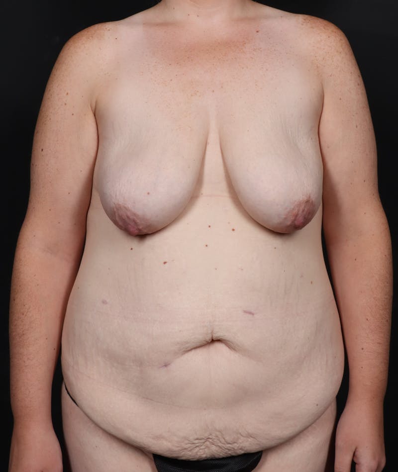 Mommy Makeover Before & After Gallery - Patient 297401 - Image 1