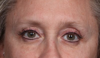 Blepharoplasty Before & After Gallery - Patient 239869 - Image 2