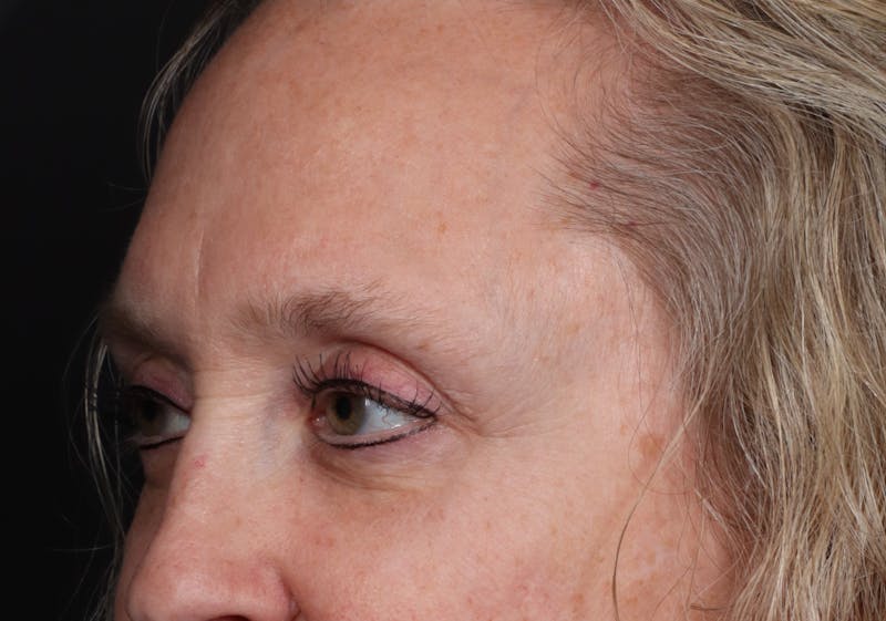 Blepharoplasty Before & After Gallery - Patient 239869 - Image 4