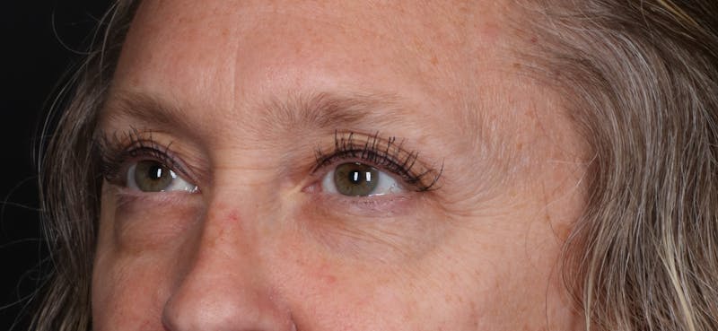 Blepharoplasty Before & After Gallery - Patient 239869 - Image 3