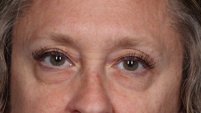Blepharoplasty Before & After Gallery - Patient 239869 - Image 1