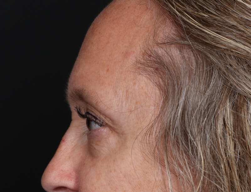 Blepharoplasty Before & After Gallery - Patient 239869 - Image 5
