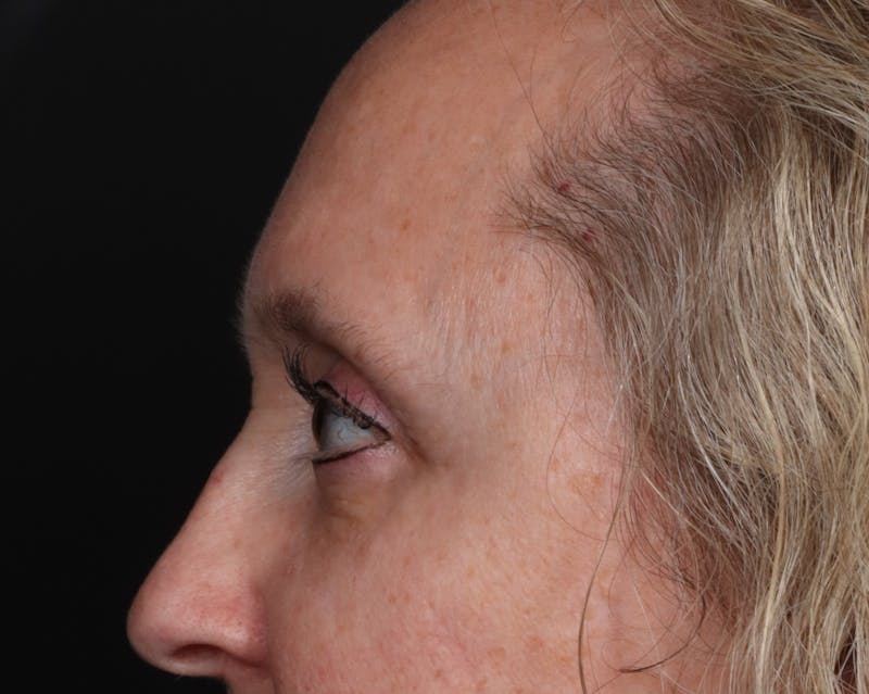 Blepharoplasty Before & After Gallery - Patient 239869 - Image 6