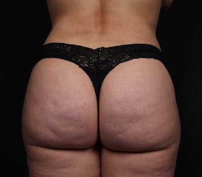 Brazilian Butt Lift Before & After Gallery - Patient 609418 - Image 2