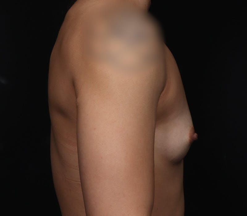 Breast Augmentation Before & After Gallery - Patient 301825 - Image 3