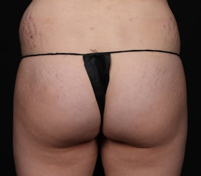 Brazilian Butt Lift Before & After Gallery - Patient 277724 - Image 1