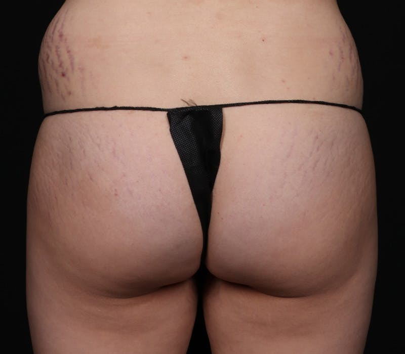 Brazilian Butt Lift Before & After Gallery - Patient 277724 - Image 1
