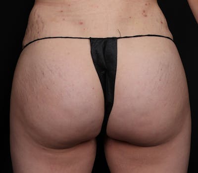 Brazilian Butt Lift Before & After Gallery - Patient 277724 - Image 2