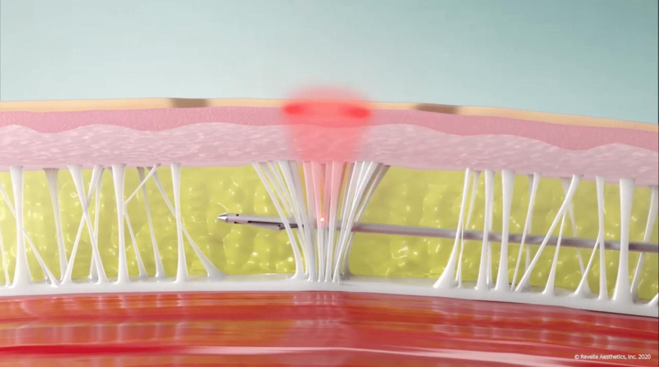 Cellulite removal graphic