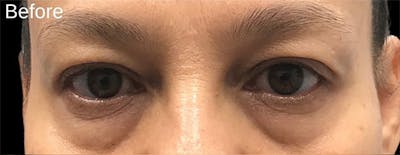 Blepharoplasty Before & After Gallery - Patient 292018 - Image 1