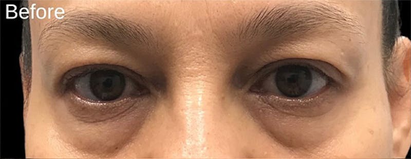Blepharoplasty Before & After Gallery - Patient 292018 - Image 1